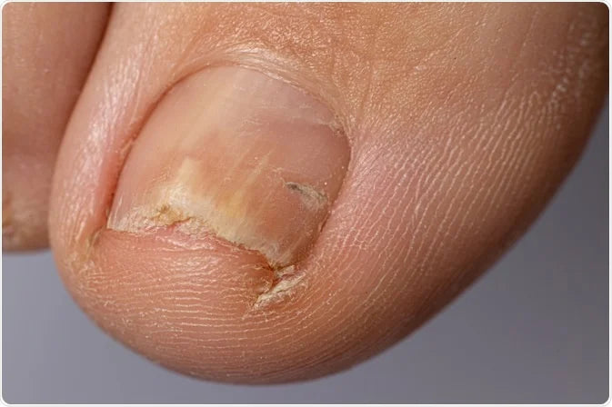 Onychomycosis Repair Bacteriostatic Liquid designed to treat fungal nail infections