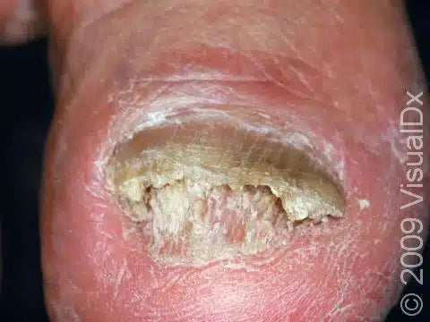 Onychomycosis Repair Bacteriostatic Liquid designed to treat fungal nail infections